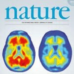 エーザイ株がストップ高!アルツハイマー新薬「アデュカヌマブ」とは?